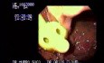 Percutaneous Endoscopic Gastrostomy (3 of 3)
