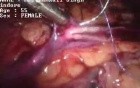 Laparoscopic pyeloplasty - female patient