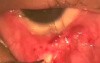 LPS plication of Marcus Gunn ptosis