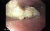 Esophageal Squamous Cell Carcinoma of the the upper third of the Esophagus that invades the subglotic (1 of 8)
