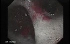 Scirrhous Gastric Carcinoma - Endoscopy (14 of 47)