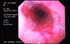 Barrett´s Esophagus (1 of 4)
