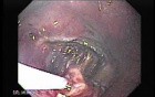 Gastrointestinal Stromal Tumor - GIST (8 of 65)