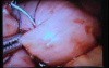 Jejunal Gastrointestinal Stromal tumor (GIST) (73 of 86)