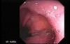 Barrett's Esophagus of long segment - hiatus hernia (16 of 24)