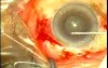 Phacoemulsification - SICS