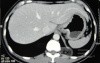 Endoscopy of Scirrhous Gastric Carcinoma involving the entire Fundus, Body and the Antrum (21 of 47)