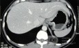 Endoscopy of Scirrhous Gastric Carcinoma involving the entire Fundus, Body and the Antrum (21 of 47)