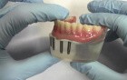 4-Implant Ball Attachment Overdenture - Model Demonstration