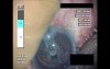 Cataract Surgery XI - Part 2