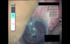 Cataract Surgery XI - Part 2