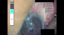 Cataract Surgery XI - Part 2