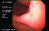 Intraluminal Endoscopic Suturing - Assessment of the Mucosa