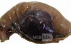 Jejunal Gastrointestinal Stromal tumor (GIST) (6 of 86)