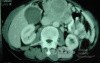 Gastric Ulcer with Gastrocolic fistula due to a Zollinger-
 Ellison Syndrome (28 of 33)