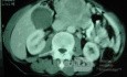 Gastric Ulcer with Gastrocolic fistula due to a Zollinger-
 Ellison Syndrome (28 of 33)