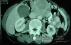 Gastric Ulcer with Gastrocolic fistula due to a Zollinger-
 Ellison Syndrome (28 of 33)