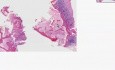Adenocarcinoma, metastatic - Histopathology - Bone, vertebra