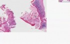 Adenocarcinoma, metastatic - Histopathology - Bone, vertebra