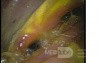 Endoscopic Image Of Postoperative State After Billroth's Operation II