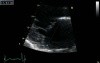 Mitral Regurgitation