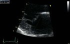 Mitral Regurgitation