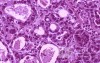Gallbladder Adenocarcinoma and litiasis (12 of 13)