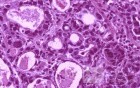 Gallbladder Adenocarcinoma and litiasis (12 of 13)