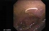 Aswhipworm in the cecum