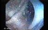 Sigmoid Diverticulitis - Colovesical Fistula (5 of 8)