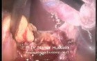 Right donor nephrectomy - Laparoscopic Approach