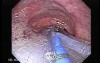Esophagus - Pneumatic Dilation for Achalasia - Beginning of the Procedure