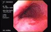 Barrett's Esophagus of long segment (1 of 24)
