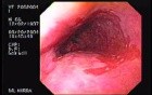 Barrett's Esophagus of long segment (1 of 24)