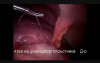 Laparoscopic Operation for Perforated Peptic Ulcer