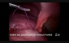 Laparoscopic Operation for Perforated Peptic Ulcer
