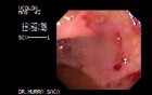 Amebic Colitis 3