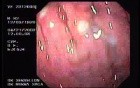 Acute Bleeding - Closer Look at the Source, Part 2