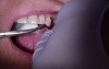 Bridge Insert: Checking The Strength And Location Of Interproximal Contacts