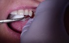 Bridge Insert: Checking The Strength And Location Of Interproximal Contacts