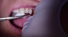 Bridge Insert: Checking The Strength And Location Of Interproximal Contacts