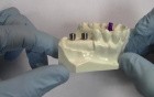 Dental Implant Staging Model - Model Demonstration
