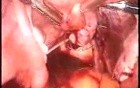 Laparoscopic Myomectomy