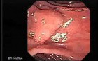 Larynx with Jaundice (5 of 6)