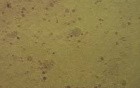 Prostatic Secretions - Pap Smear