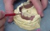 Denture Wrought Wire Clasp Repair - Discussion With Professor Bates