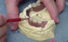 Denture Wrought Wire Clasp Repair - Discussion With Professor Bates
