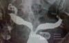 HSG SEPTSTE UTERUS