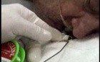 Paggage Of The Needle With Thread Through The Mouthpiece For Gastroplicature