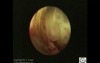 Cervical Ectopic Pregnancy 